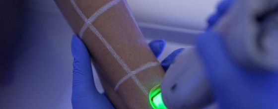 LASER TREATMENTS